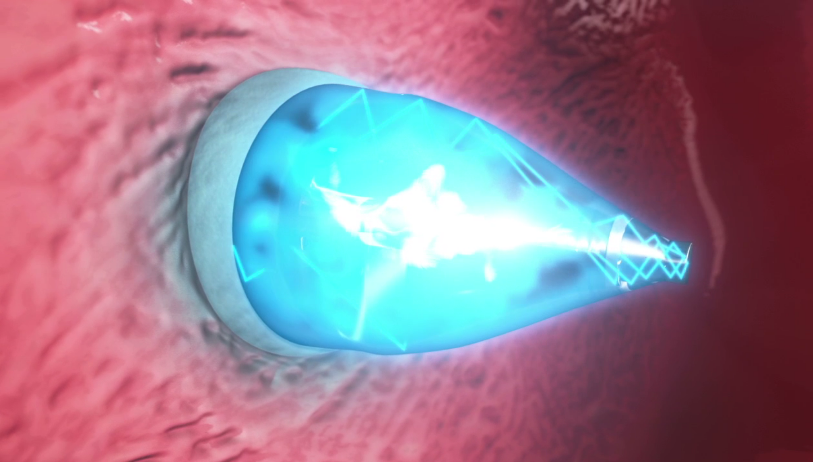 Il catetere smart a luce UV: interventi al cuore senza chirurgia